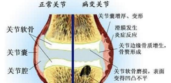 膝关节骨质增生,最全解答(含锻炼方法和防、治