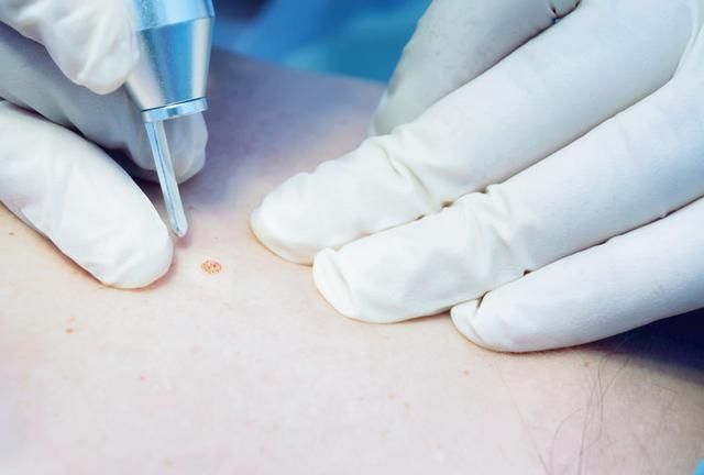 身上的痣,该如何去掉?3个方法,各有所长