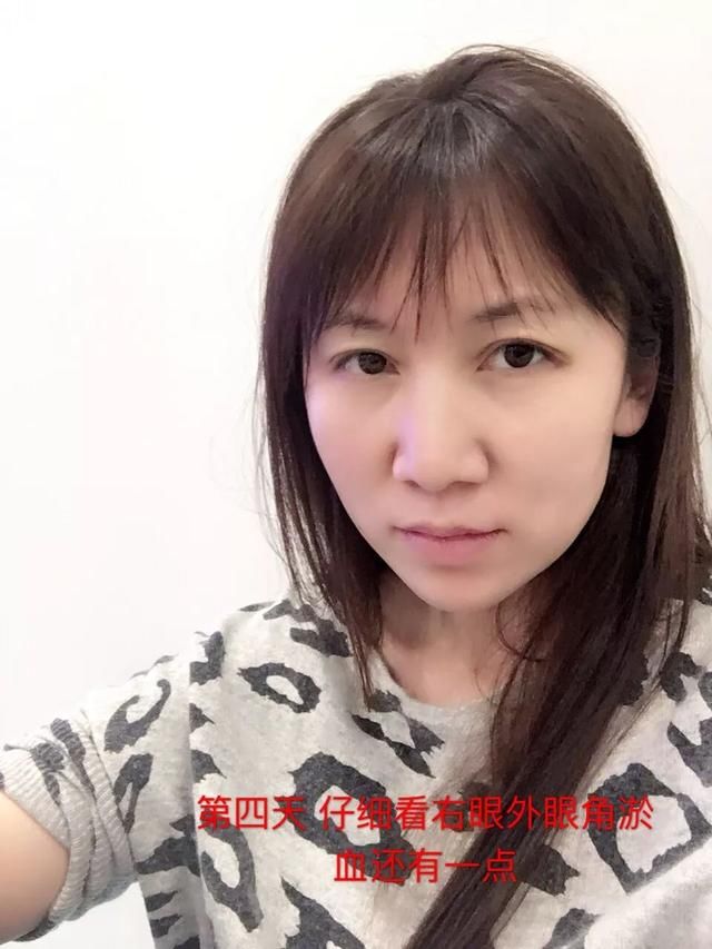 “拜拜肉”减不掉！眼皮松得不敢拍照！看来是时候展现新的技术了