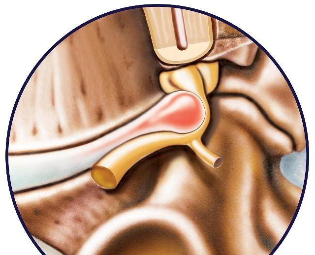 颈椎间盘突出的原因:从中西医两个角度来分析