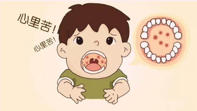 孩子发烧咽喉出现疱疹,吃药没好转,可能是这种