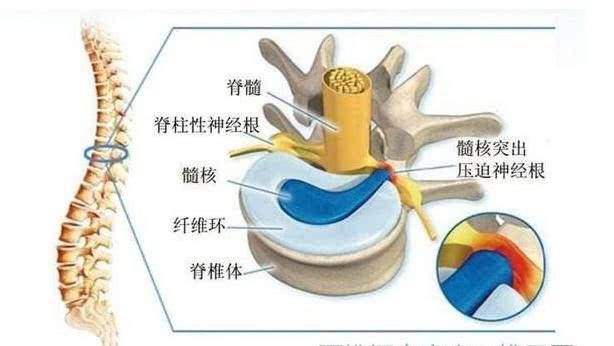 腰椎病这3个动作不坚持，这2个习惯不注意，再好的药也没有用!