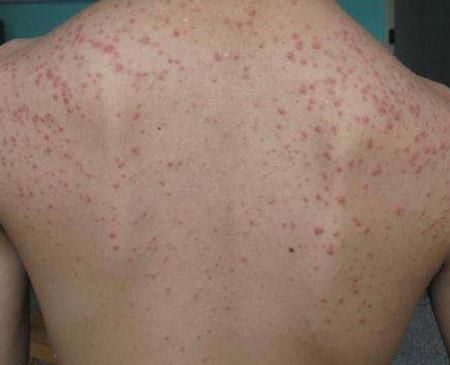 中药如何治疗背部痤疮