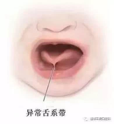 口腔问题早发现,为什么要进行舌系带筛查?