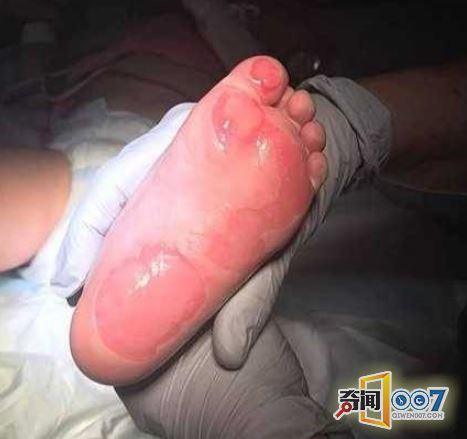 18月大女婴公园学步双脚惊现大片血泡,元凶竟
