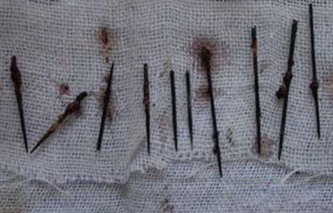 男婴的脑袋里被插了十根针,真相让所有人都愤