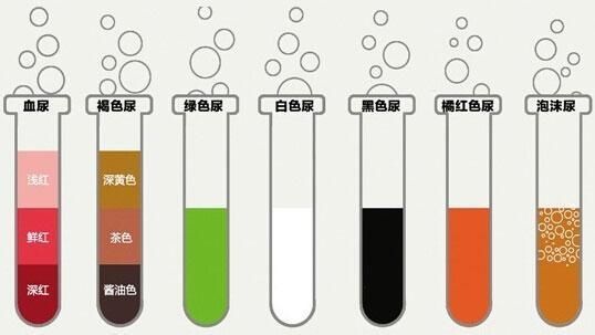 你的尿液如何是这种颜色, 当心是身体出现大问
