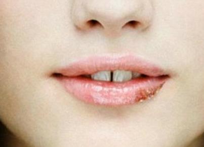 嘴上火起泡?比吃药还管用的小方法!