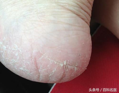 脚后跟干裂脱皮是怎么回事儿?送你几个嫩足小妙方!