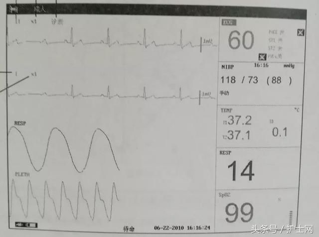 心电监护仪上的这个数值你认识吗?