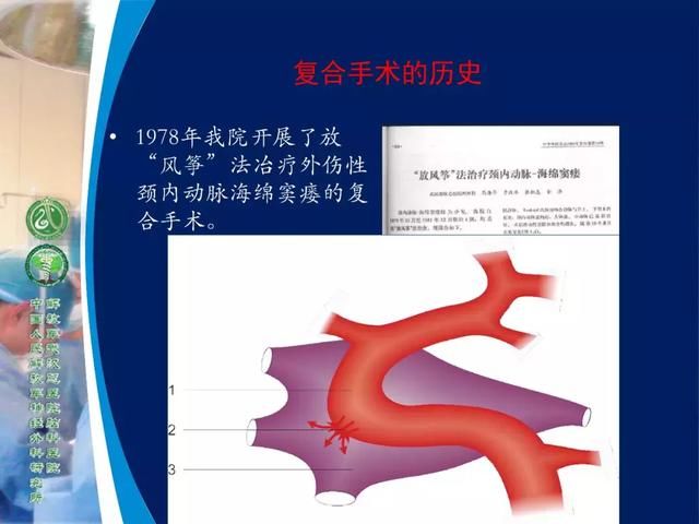 39年前开创“复合手术”，治愈颅底高位颈内动静脉瘘
