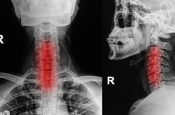 老大爷颈椎疼18年, 花了数十万! 没想到被一颗