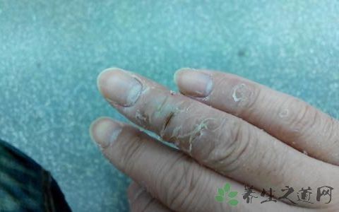 皮炎和湿疹有什么区别