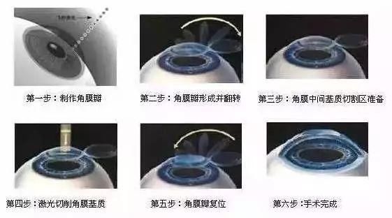 做眼睛近视手术的原理_做近视手术前必须要做眼部检查,医生根据检查的结果,评估你是否适合(3)