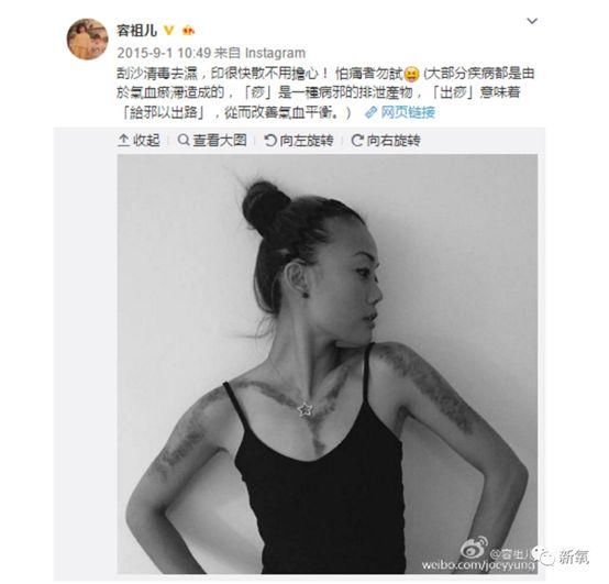 阿娇晒刮痧照吓瘫网友…“像被烧伤了”!