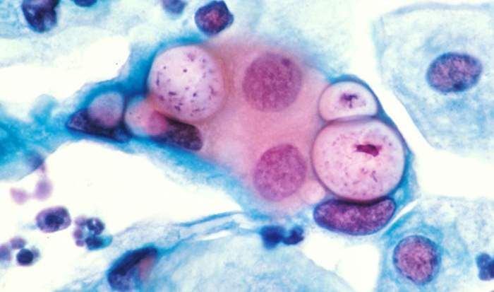 权威专家科普:HPV病毒与尖锐湿疣的前世今生