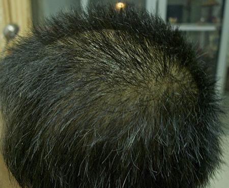 男性脂溢性脱发有哪些治疗方法