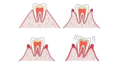 老人牙齿松动怎么办