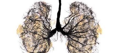 呼吸科主任提醒:下面5个症状是肺癌早期征兆!