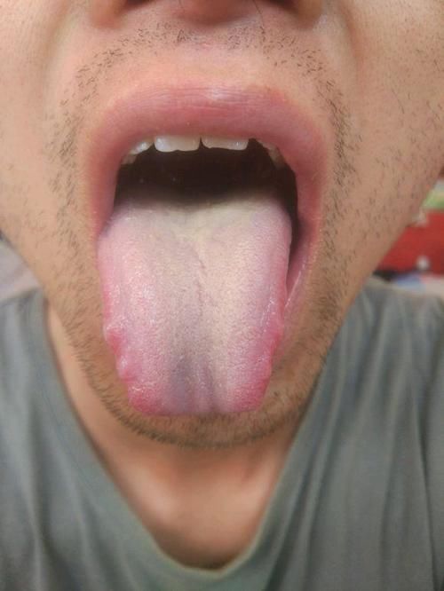 义务舌诊:脾胃湿寒、肝郁血于、肝脾不和的舌