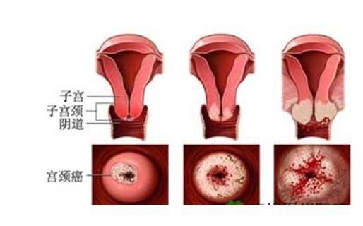 16岁女孩腹痛出血，查出宫颈癌晚期，痛恨：都是爸爸害的