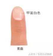 指甲不正常,问题可不小 出现这种情况,小心脑溢