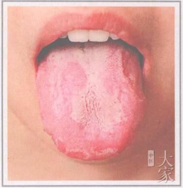 舌诊丨小儿几种舌苔剥苔的详解分析