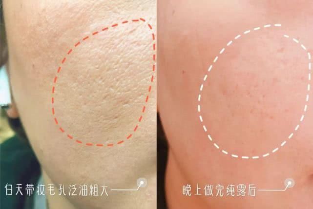 脸绷是激素脸吗