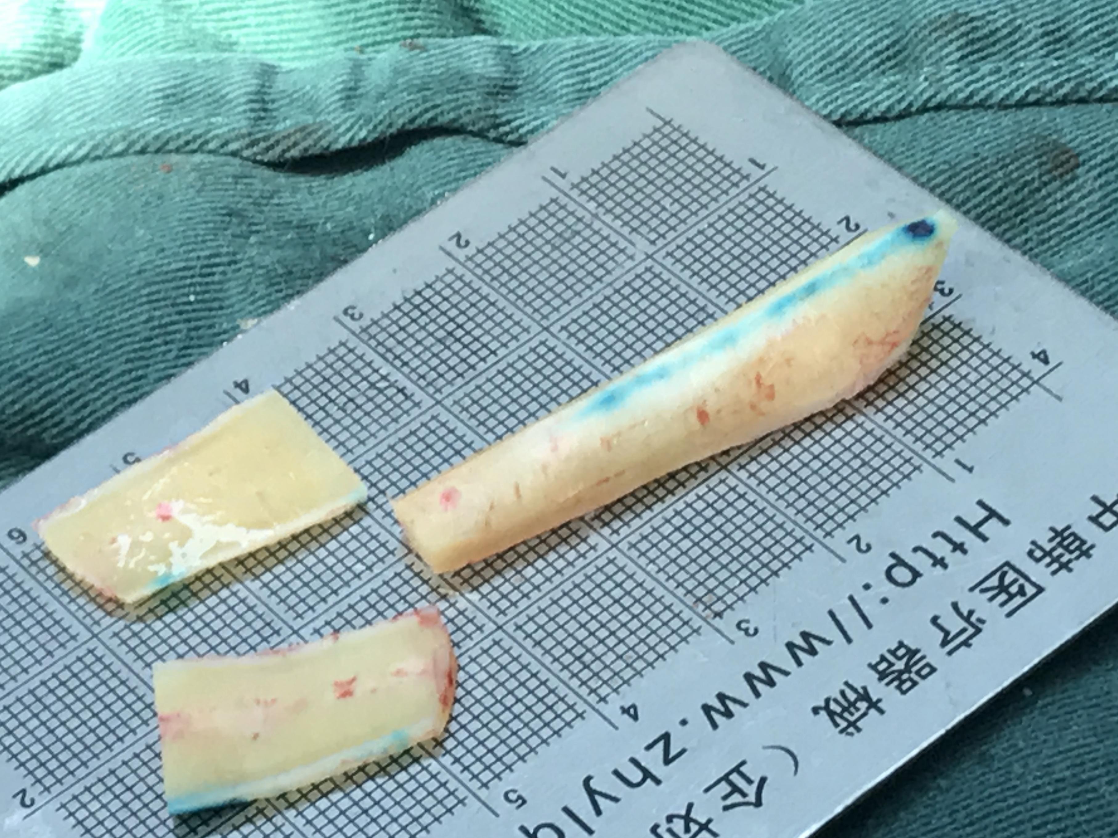 【卢丙仑琅丽】隆鼻材料之--钙化了的肋软骨