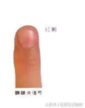 指甲不正常,问题可不小 出现这种情况,小心脑溢