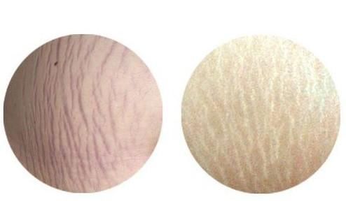 去肥胖纹最好的办法是什么 专家揭秘去肥胖纹