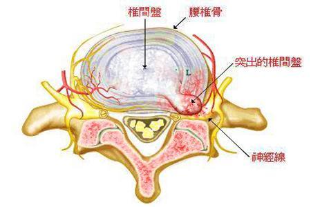 腰椎间盘突出不压迫神经不用治
