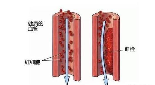 6个信号暗示你，血栓出现了，5种天然食物，是抗血栓“高手”