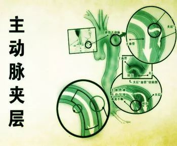 【健康】打个喷嚏也会要命?小心你血管里这颗\＂不定时炸弹\＂!