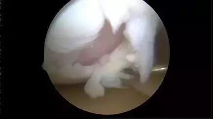 我想健康跑步一辈子：怎样跑步才能防止关节软骨磨损