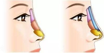 国产威宁假体隆鼻好吗?和膨体隆鼻的区别是什