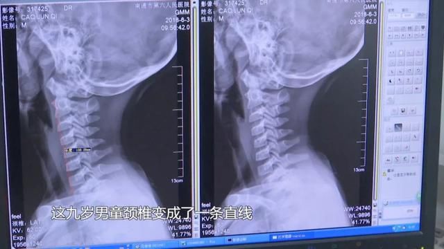 长时间低头玩手机 南通一9岁小学生颈椎变形