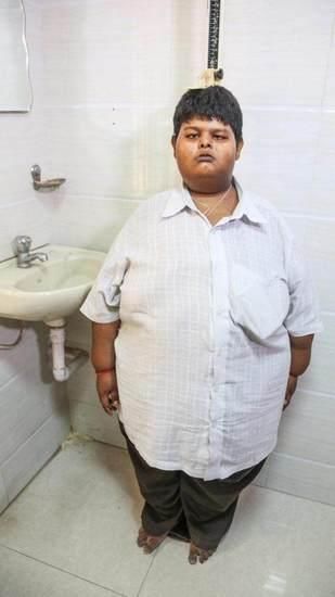 印度15岁男孩体重299斤,手术成功减掉90斤赘