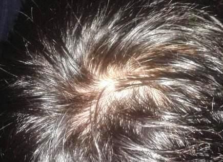 头发出油,掉发严重?可能是有头螨!用一勺油,让