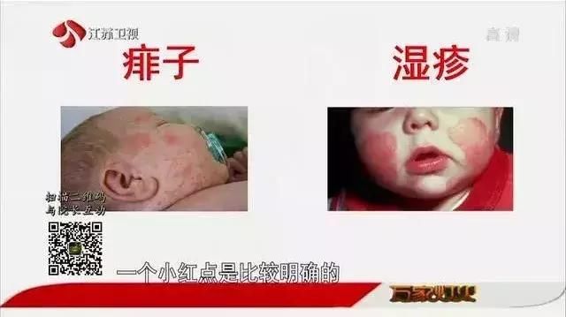 痱子湿疹傻傻分不清？最全湿疹指南，教你辨清症状，远离瘙痒~