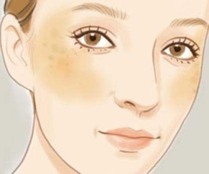 脸上斑点越来越多原因:斑点是如何形成的及应