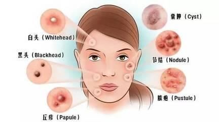 便秘会导致黄褐斑、皮肤出现痘痘?该怎么办呢