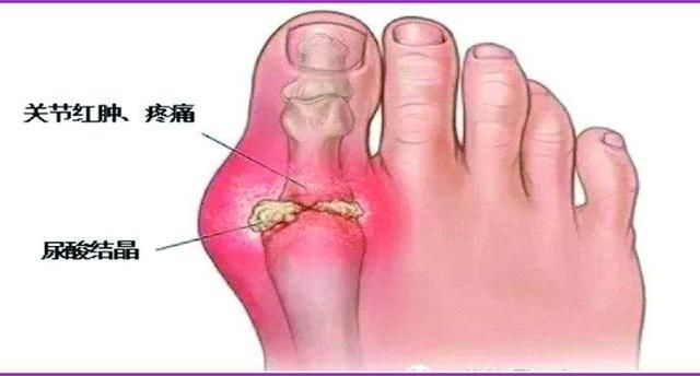 高尿酸降不下来?CCTV《健康之路》推荐的食疗方，尿酸高必学!_【快资讯】