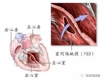 先天性心脏病,没你想得那么可怕