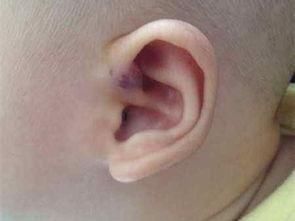 先天性耳前瘘管的并发症有哪些