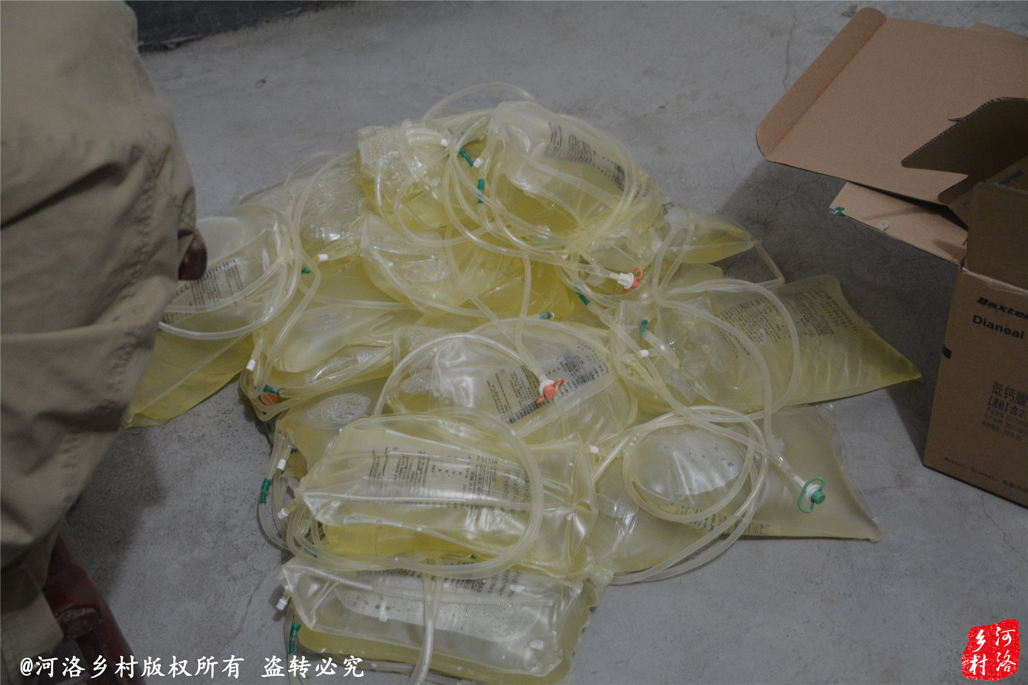 小伙每天从肚子抽2升水 自建透析室