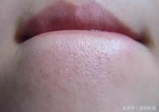 粉底都盖不住的闭口该怎么办?