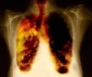 肺癌的6大早期症状,不吸烟也应知晓,早发现、