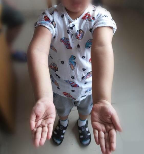 肘内翻除了不好看,还有什么影响?