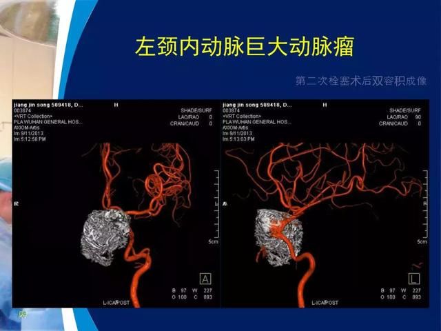 39年前开创“复合手术”，治愈颅底高位颈内动静脉瘘